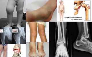 Ревматоидный артрит у детей — симптомы и лечение