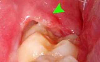 Зубы мудрости: строение, особенности роста, показания для удаления