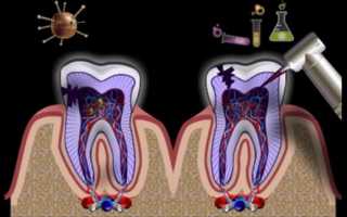 Воспаление корня зуба и зубных каналов: признаки, симптомы и лечение