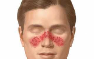 Покраснение носа: причины, симптомы и связь с болезнями, как избавиться и лечить