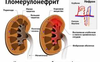 Симптоматика гломерулонефрита при беременности: лечение, профилактика и прогноз