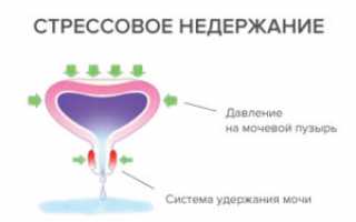 Лечение стрессового недержания мочи у женщин