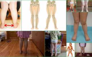 Как исправить Х-образные ноги у детей?