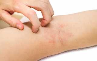Аллергический дерматит у взрослых — лечение, причины, симптомы