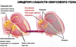 Что означает диагноз — синдром слабости синусового узла (СССУ)?