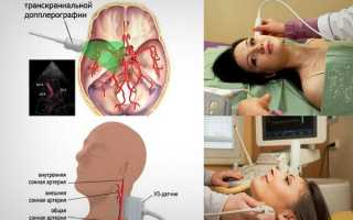 Что такое УЗДГ брахиоцефальных артерий (БЦА): как проводится и что показывает, расшифровка