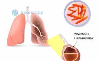 Легионеллез: возбудитель, формы, признаки, терапия, профилактика