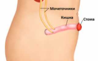 Что такое уростома, уход за ней, как дальше жить