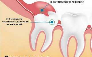 Нужно ли удалять зубы мудрости: зачем и в каких случаях удаляют