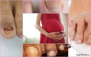Чем и как лечить грибок ногтей при беременности?