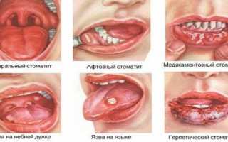 Стоматит во рту у взрослых: бывает ли, как и чем лечат