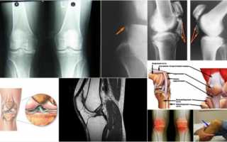 Что такое лигаментоз коленного сустава и как его лечить?