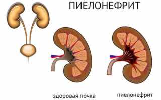 Лечебная физкультура при пиелонефрите: комплексы упражнений и особенности терапии