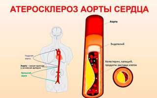 Атеросклероз аорты сердца: симптомы, лечение, осложнения