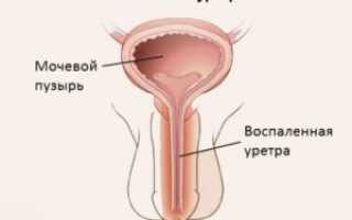 Уретрит: признаки и лечение острой и хронической формы у мужчин