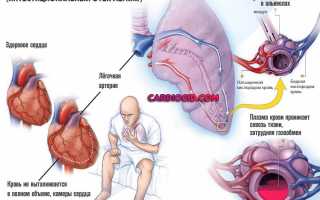 Особенности сердечной астмы