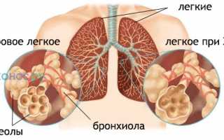 ХОБЛ: причины, классификация, диагностика, как лечить и предотвратить