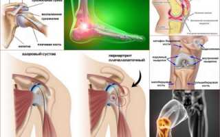 Периартрит — что это такое, как лечить патологию?