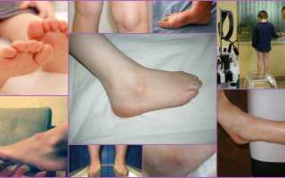 Симптоматика и лечение гигромы у ребенка на ногах
