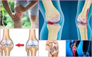 Что такое остеоартроз (остеоартрит) коленного сустава, чем и как его лечить?
