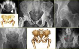 Симптомы и лечение деформирующего артроза (коксартроза) тазобедренного сустава
