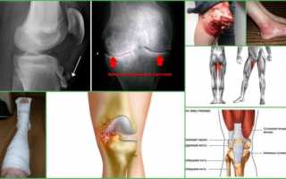 Что такое контрактура коленного сустава и как ее лечить?