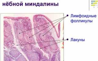 Гнойники на миндалинах и гландах: причины и лечение