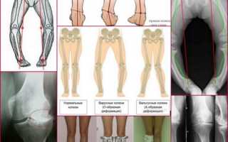 Вальгусная деформация коленных суставов