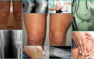 Симптомы и лечение тендинита колена