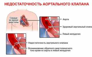 Что такое недостаточность аортального клапана?