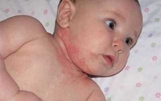 Аллергический дерматит у детей — фото, лечение, симптомы и причины