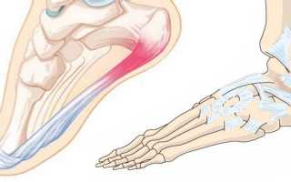 Подошвенный фасциит: причины, симптомы и методы лечения
