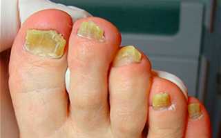 Грибок ногтей на ногах — лечение, причины, симптомы