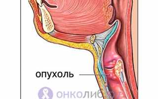 Рак гортани: симптомы, признаки начальной стадии, как выявить и лечить