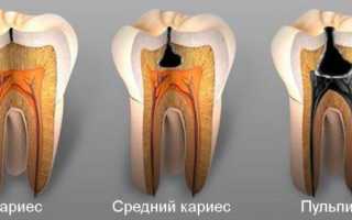 Почему болит зуб при нажатии, надавливании и надкусывании