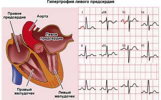 Что такое гипертрофия левого предсердия и почему она возникает?