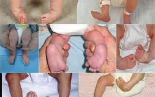 Причины и лечение косолапости у новорожденных