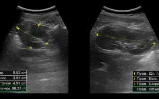 Что покажет УЗИ мочевого пузыря и почек, как его делают и расшифровывают результаты