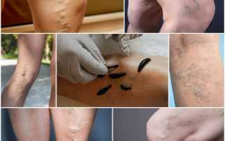 Гирудотерапия при варикозе вен на ногах