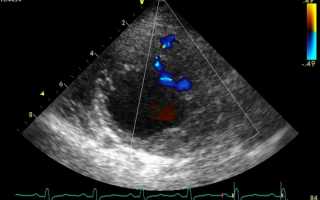 Что такое эхокардиография с допплером: подготовка, показания, расшифровка протокола