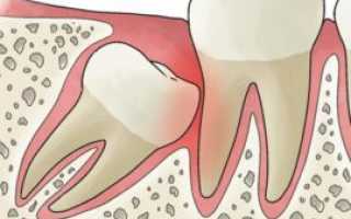 Дистопированные и ретинированные зубы: сущность патологии, удаление