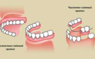 Правила ухода за съемными зубными протезами, способы хранения протезов