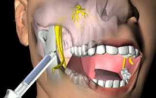 Виды современных методов анестезии в стоматологии, препараты для обезболивания