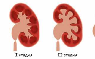 Гидроуретеронефроз — патология почек и мочевыводящих путей