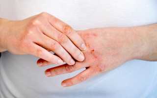 Атопический дерматит у взрослых — лечение, причины, симптомы