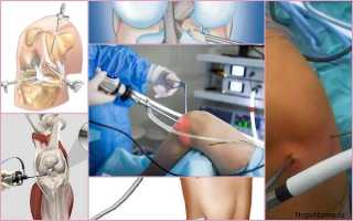 Проведение операции и восстановление после артроскопии мениска коленного сустава