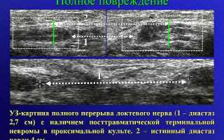 Как и где делают УЗИ нервов, что показывает и как расшифровать протокол правильно