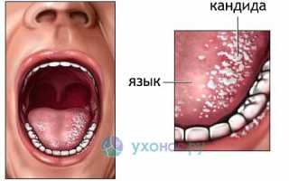 Грибок в горле (Кандида и другие): признаки, лечение, причины и профилактика