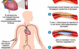 Стентирование сосудов, образ жизни после операции