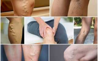 Болят ноги при варикозе — что делать?